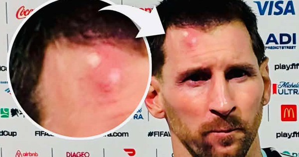 Messi sưng vêu trán sau trận thắng Cabo Verde: Vì sao nên nỗi? - hình ảnh - u888app.vip